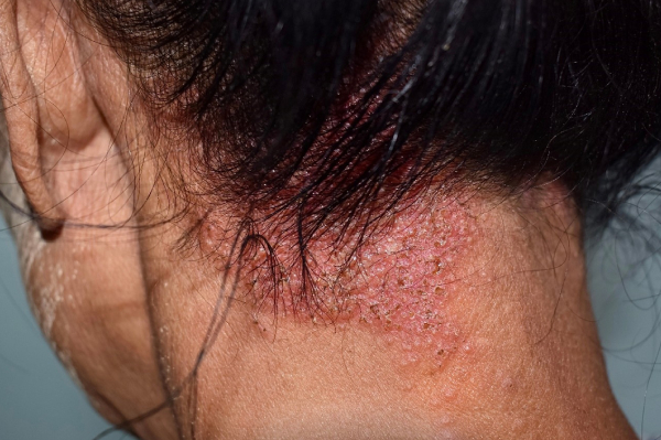 Dermatitis