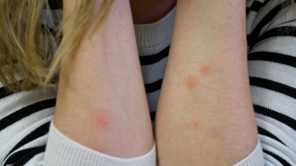 A person with visible red bites on their arms, suggesting possible insect bites from termites.


